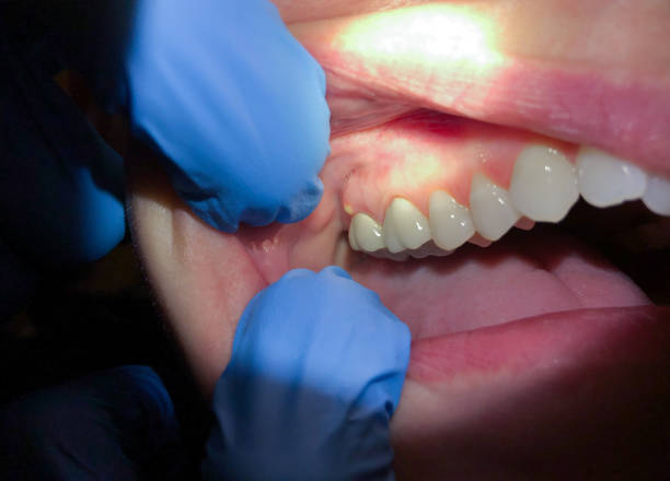 Best Emergency Dental Care for Abscessed Tooth in Friona, TX